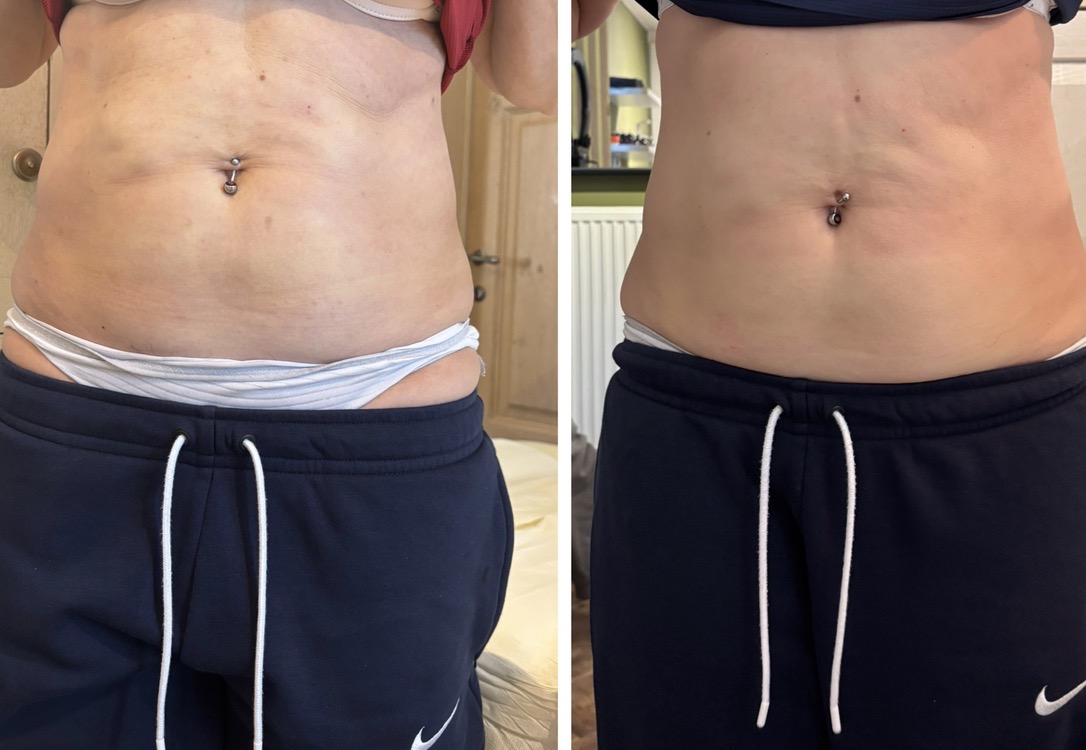 Hifu voor en na foto - huidverstrakking buik