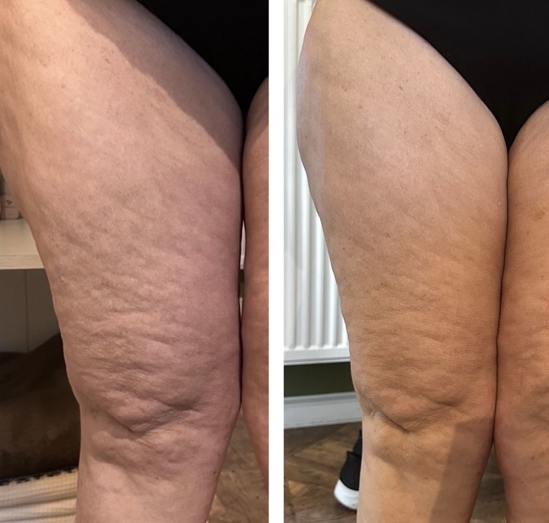 Hifu voor en na resultaat - cellulite behandeling