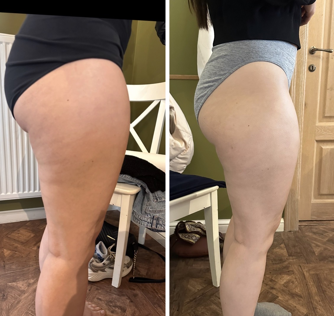 Hifu voor en na foto - huidverstrakking bovenbenen