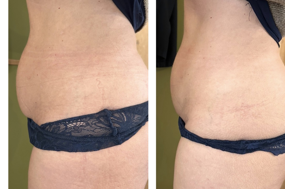 Hifu voor en na resultaat - contour verbetering buik
