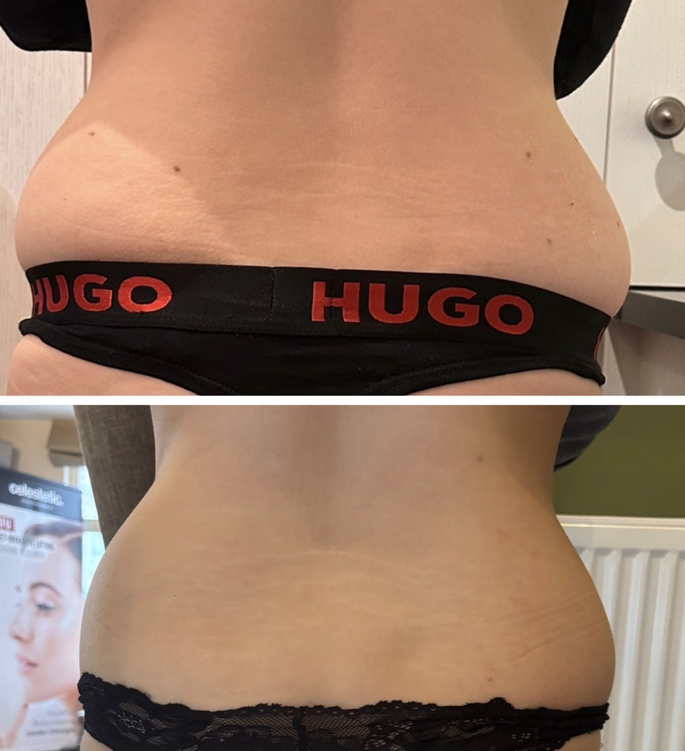 Hifu voor en na contourbehandeling taille