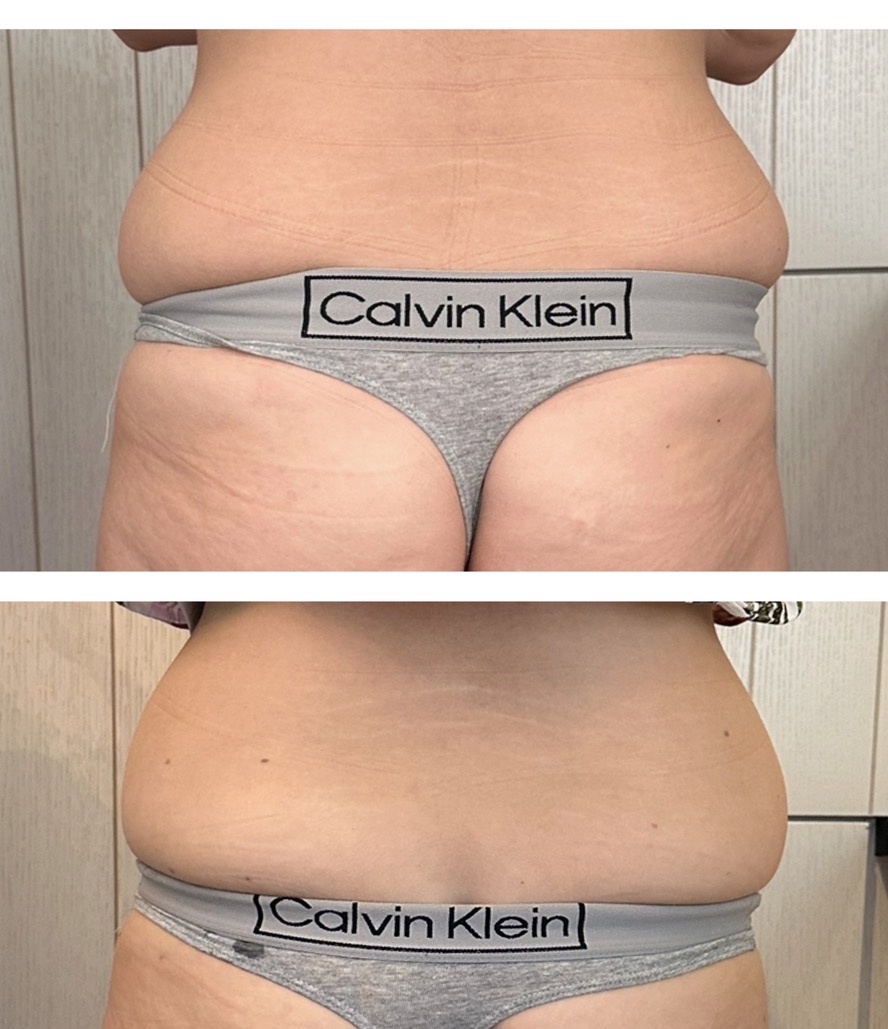 Hifu voor en na resultaat - afslanken lovehandles