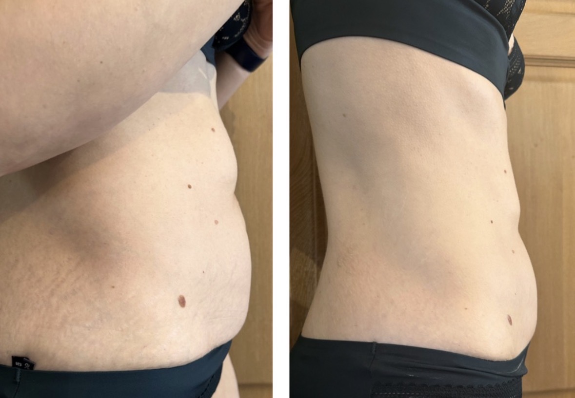 Hifu voor en na foto - buikverstrakking