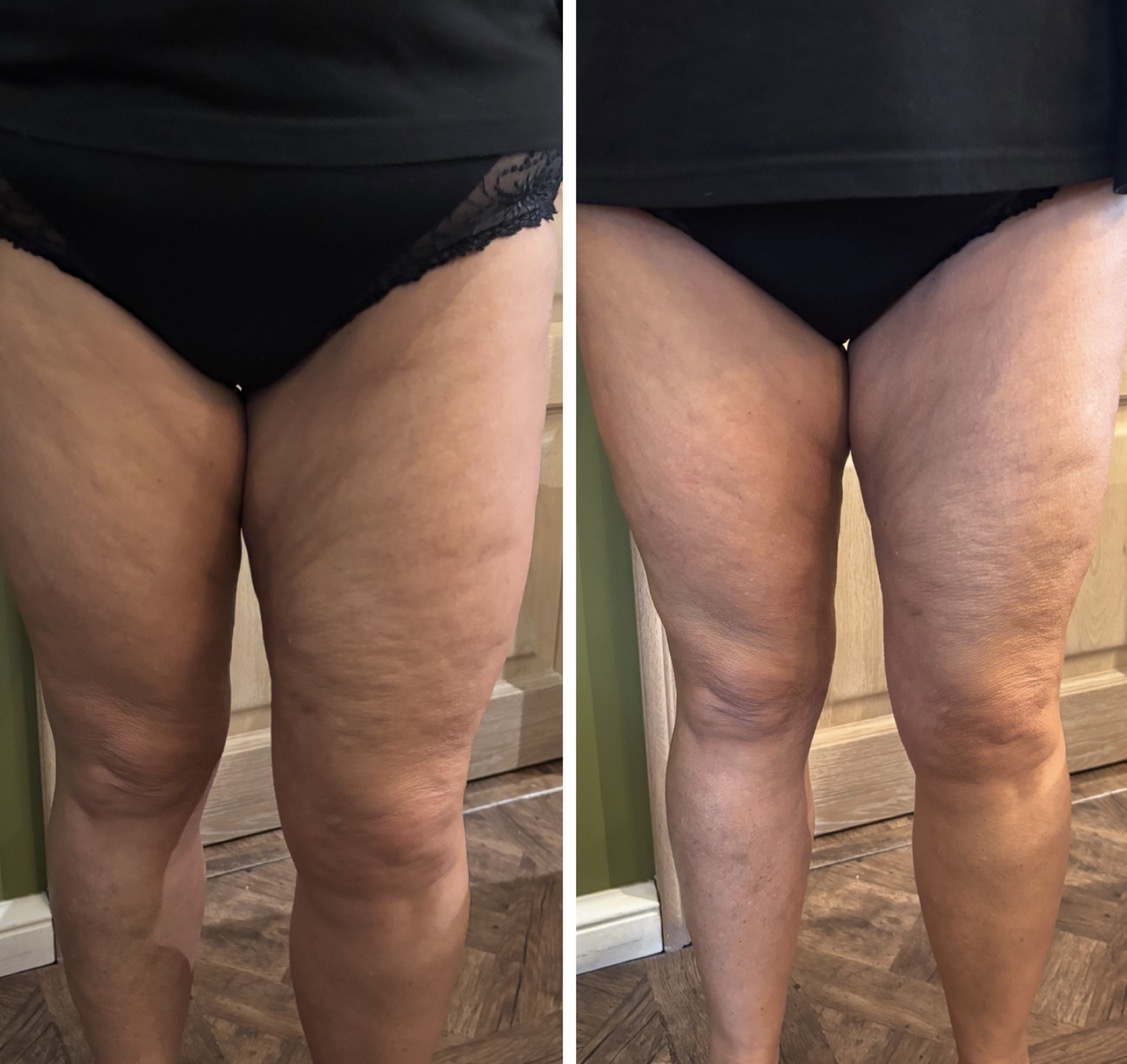 Hifu voor en na foto - verbetering huidstructuur cellulitis