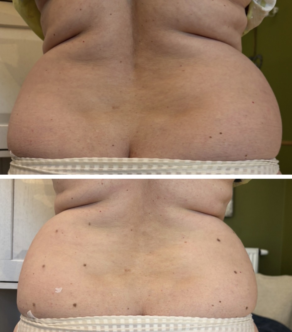 Hifu voor en na foto - contourverbetering flank