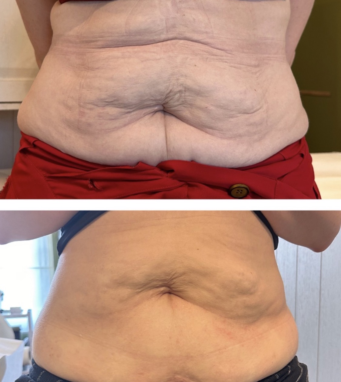Hifu voor en na foto - huidversteviging buik